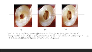Access opening of a maxillary premolar: (a) Circular access opening in the central groove would lead to
missing one of the two canals. (b) Buccolingual extension of the access preparation would lead to straight line access
of both the canals. (c) Buccal and palatal canals after orifice enlargement.
(a) (b) (c)
 