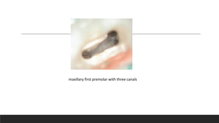 maxillary first premolar with three canals
 