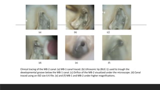 Clinical tracing of the MB-2 canal: (a) MB-1 canal traced. (b) Ultrasonic tip (BUC-1) used to trough the
developmental groove below the MB-1 canal. (c) Orifice of the MB-2 visualized under the microscope. (d) Canal
traced using an ISO size 6 K-file. (e) and (f) MB-1 and MB-2 under higher magnifications.
(a) (b) (c)
(d) (e) (f)
 