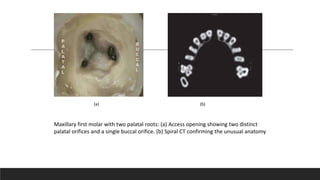 Maxillary first molar with two palatal roots: (a) Access opening showing two distinct
palatal orifices and a single buccal orifice. (b) Spiral CT confirming the unusual anatomy
(a) (b)
 