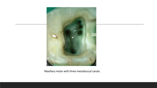 Maxillary molar with three mesiobuccal canals.
 