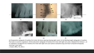 (a) Preoperative radiograph of maxillary first molar. (b) Access opening showing eight canals. (c)–(e) Working length radiographs of maxillary
first molar in eccentric angulations. (f) Post obturation radiograph of maxillary first molar with eight root canals. (Adapted from Kottoor, J., et
al. Endodontic management of a maxillary first molar with eight root canal systems evaluated using cone-beam computed tomography
scanning: A case report.
J. Endod., 37(5), 715, 2011.)
(a) (b) (c)
(d) (e) (f)
 