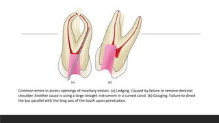 Common errors in access openings of maxillary molars: (a) Ledging. Caused by failure to remove dentinal
shoulder. Another cause is using a large straight instrument in a curved canal. (b) Gouging. Failure to direct
the bur parallel with the long axis of the tooth upon penetration.
(a) (b)
 