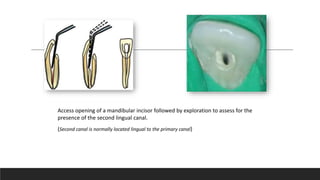 Access opening of a mandibular incisor followed by exploration to assess for the
presence of the second lingual canal.
(Second canal is normally located lingual to the primary canal)
 