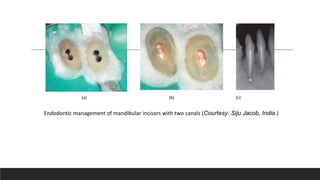 Endodontic management of mandibular incisors with two canals (Courtesy: Siju Jacob, India.)
(a) (b) (c)
 