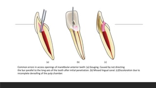 Common errors in access openings of mandibular anterior teeth: (a) Gouging. Caused by not directing
the bur parallel to the long axis of the tooth after initial penetration. (b) Missed lingual canal. (c)Discoloration due to
incomplete deroofing of the pulp chamber.
(a) (b) (c)
 