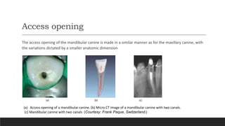 Access opening
The access opening of the mandibular canine is made in a similar manner as for the maxillary canine, with
the variations dictated by a smaller anatomic dimension
(a) Access opening of a mandibular canine. (b) Micro CT image of a mandibular canine with two canals.
(c) Mandibular canine with two canals (Courtesy: Frank Paque, Switzerland.)
(a) (b) (c)
 