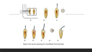 Steps in the access opening of a mandibular first premolar.
(a) (b) (c)
(d) (e) (f) (g) (h)
 