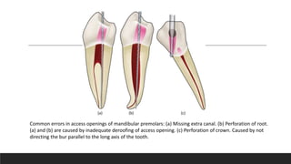 Common errors in access openings of mandibular premolars: (a) Missing extra canal. (b) Perforation of root.
(a) and (b) are caused by inadequate deroofing of access opening. (c) Perforation of crown. Caused by not
directing the bur parallel to the long axis of the tooth.
(a) (b) (c)
 