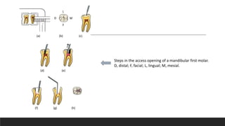 Steps in the access opening of a mandibular first molar.
D, distal; F, facial; L, lingual; M, mesial.
(a) (b) (c)
(d) (e)
(f) (g) (h)
L
F
M
D
 