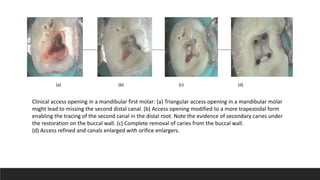 Clinical access opening in a mandibular first molar: (a) Triangular access opening in a mandibular molar
might lead to missing the second distal canal. (b) Access opening modified to a more trapezoidal form
enabling the tracing of the second canal in the distal root. Note the evidence of secondary caries under
the restoration on the buccal wall. (c) Complete removal of caries from the buccal wall.
(d) Access refined and canals enlarged with orifice enlargers.
(a) (b) (c) (d)
 