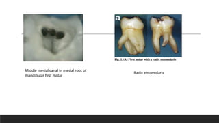 Middle mesial canal in mesial root of
mandibular first molar
Radix entomolaris
 