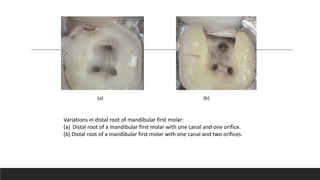 Variations in distal root of mandibular first molar:
(a) Distal root of a mandibular first molar with one canal and one orifice.
(b) Distal root of a mandibular first molar with one canal and two orifices.
(a) (b)
 