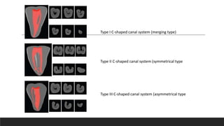 Type I C-shaped canal system (merging type)
Type II C-shaped canal system (symmetrical type
Type III C-shaped canal system (asymmetrical type
 