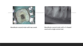 Mandibular second molar with two canals Mandibular second molar with a C-shaped
canal and a single conical root
 