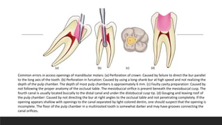 Common errors in access openings of mandibular molars: (a) Perforation of crown: Caused by failure to direct the bur parallel
to the long axis of the tooth. (b) Perforation in furcation: Caused by using a long-shank bur at high speed and not realizing the
depth of the pulp chamber. The depth of most pulp chambers is approximately 6 mm. (c) Faulty cavity preparation: Caused by
not following the proper anatomy of the occlusal table. The mesiobuccal orifice is present beneath the mesiobuccal cusp. The
fourth canal is usually located buccally to the distal canal and under the distobuccal cusp tip. (d) Gouging and leaving roof of
the pulp chamber: Caused by not directing the bur at right angles to the occlusal table and not penetrating completely. If the
opening appears shallow with openings to the canal separated by light-colored dentin, one should suspect that the opening is
incomplete. The floor of the pulp chamber in a multirooted tooth is somewhat darker and may have grooves connecting the
canal orifices.
(a) (b) (c) (d)
 