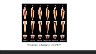 Various Access cavity designs in anterior teeth
 