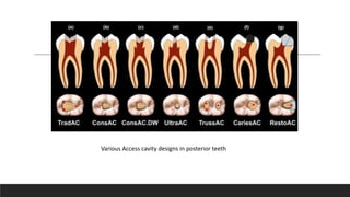 Various Access cavity designs in posterior teeth
 