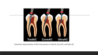 Schematic representation of NiTi instruments in Trad-AC, Cons-AC, and Ultra-AC
 