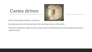 Caries driven
•Entry into the pulp chamber is carried out
by extracting caries and maintaining all the remaining structure of the tooth.
•This access design thus allows for direct conservation of healthy dentin by removing discontinuities in
tooth structure
 