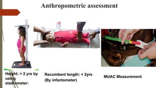 Severe Acute Malnutrition (SAM) and Nutrition Rehabilitation Centre ...