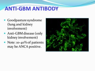 ANTI-GBM ANTIBODY
 Goodpasturesyndrome
(lung and kidney
involvement)
 Anti-GBM disease (only
kidney involvement)
 Note: 10-40%of patients
may be ANCA positive.
 