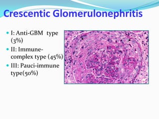 Crescentic Glomerulonephritis
 I: Anti-GBM type
(3%)
 II: Immune-
complex type (45%)
 III: Pauci-immune
type(50%)
 