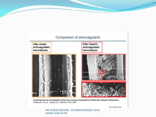DR AYMAN SEDDIK , PLASMAPHERESIS WHY ,
WHEN AND HOW
 