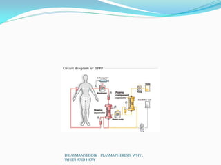 DR AYMAN SEDDIK , PLASMAPHERESIS WHY ,
WHEN AND HOW
 