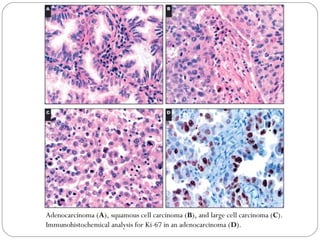 Non small cell lung cancer I | PPT