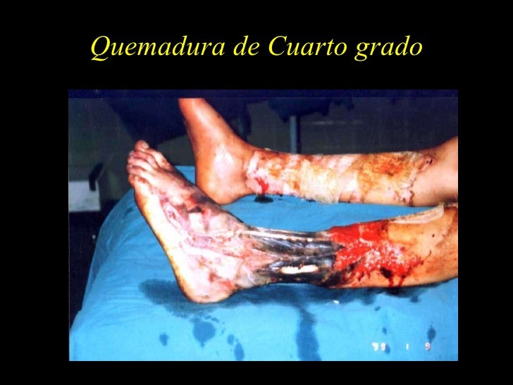 Manejo Gran Quemado Manejo Gran Quemado