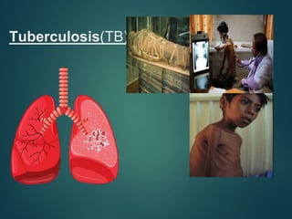 Tuberculosis(TB)
 