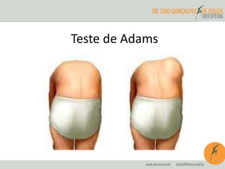 Teste de Adams
 