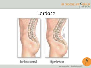 Lordose
 