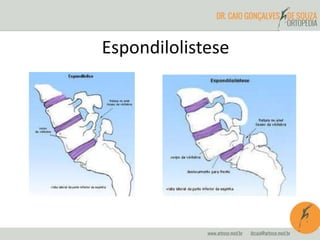 Espondilolistese
 
