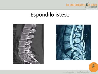 Espondilolistese
 