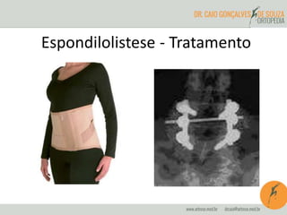 Espondilolistese - Tratamento
 