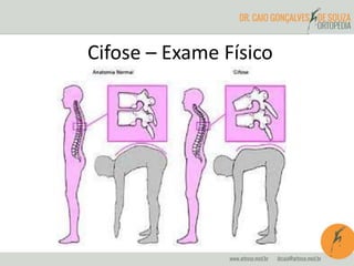 Cifose – Exame Físico
 