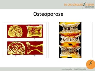 Osteoporose
 