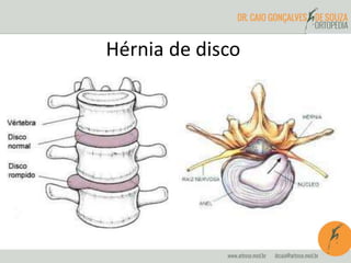 Hérnia de disco
 