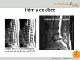 Hérnia de disco
 