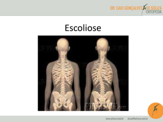 Escoliose
 