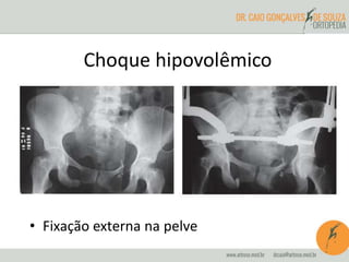 Choque hipovolêmico
• Fixação externa na pelve
 