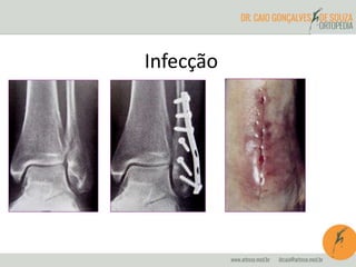 Infecção
 