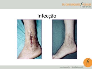 Infecção
 