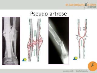 Pseudo-artrose
 