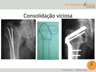Consolidação viciosa
 