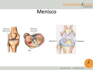 Menisco
 