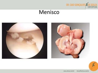 Menisco
 