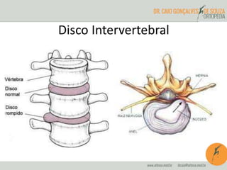 Disco Intervertebral
 